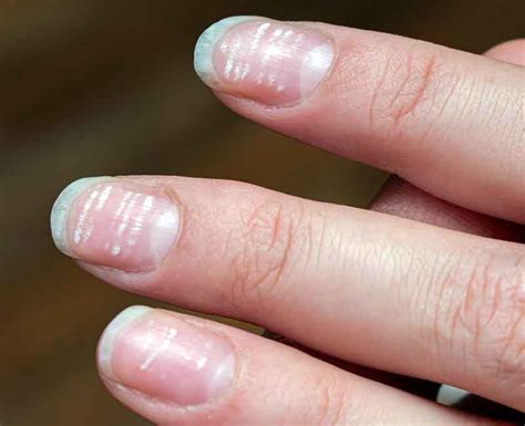 leukonychia spots result from _____.|White Spots on Nails (Leukonychia) .